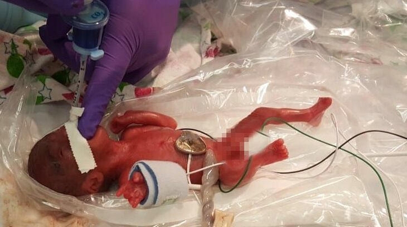 Išgyveno mažiausias pasaulyje gimęs kūdikis: naujagimis svėrė vos 245 gramus