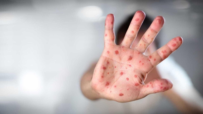 Sergamumas tymais mažėja, tačiau viruso plitimą numatyti sunku