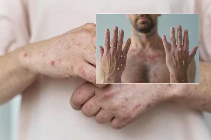 Nerimas dėl beždžionių raupų: siūlo skiepytis vyrams, lytiškai santykiaujantiems su kitais vyrais