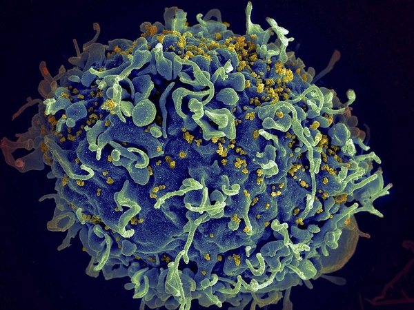 Londonietis tapo antruoju nuo ŽIV pagijusiu pacientu