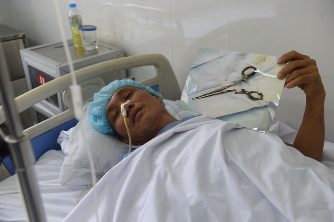 Praėjus 18 metų po operacijos, iš vyro pilvo ištrauktos žirklės